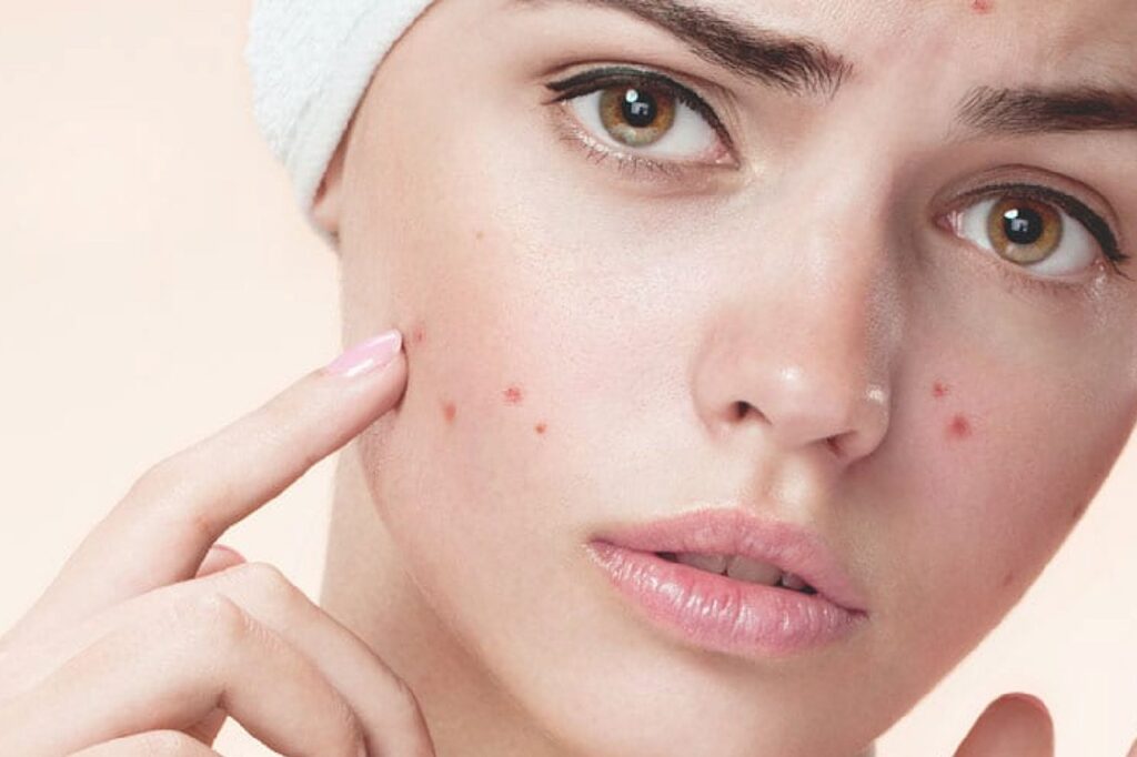 acne treatment in pardi