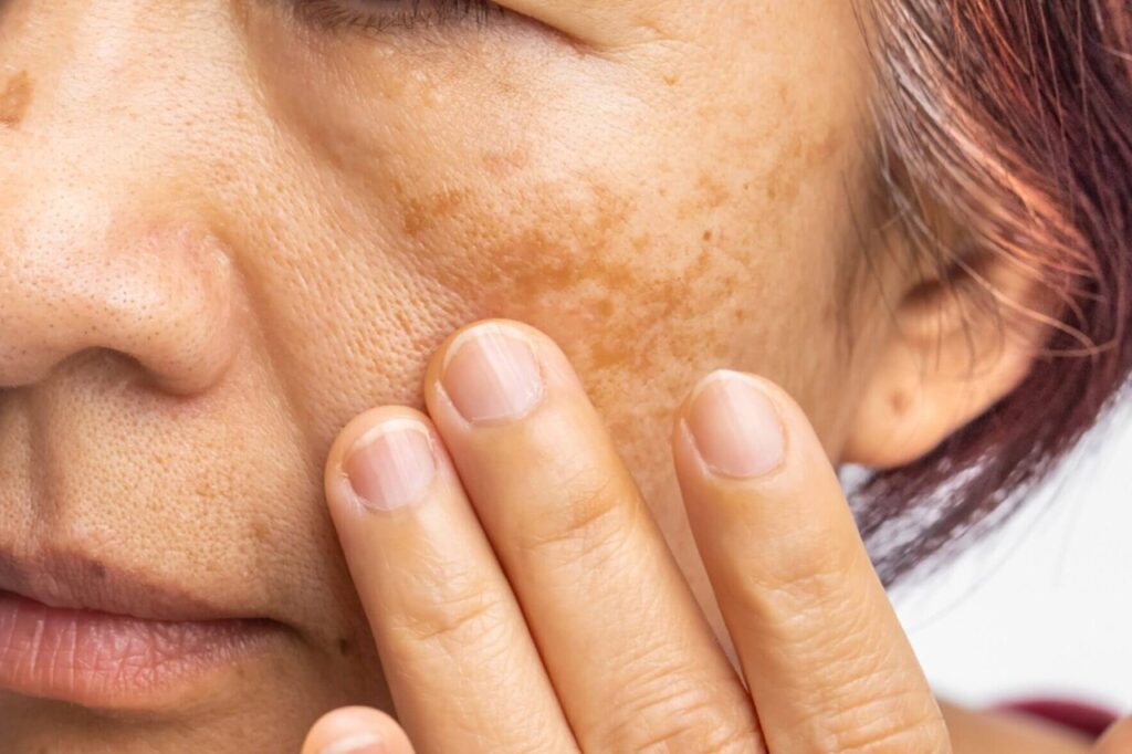 melasma treatment in pardi
